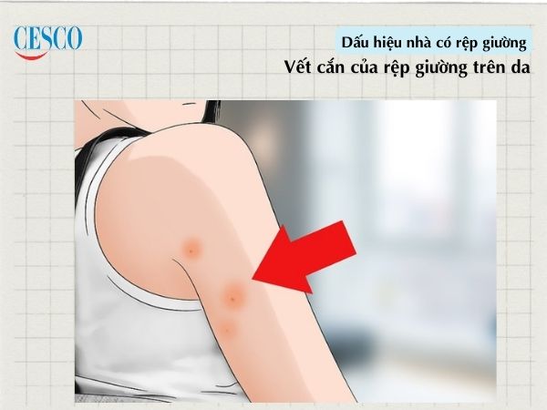vết cắn của rệp giường cũng là dấu hiệu có rệp xuất hiện trên giường, nệm trong nhà